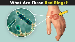 Ringworm Disease Tinea  Symptoms Causes And Treatment UrduHndi [upl. by Anomas]