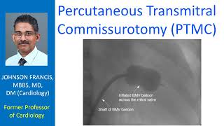 Percutaneous Transmitral Commissurotomy PTMC [upl. by Baecher]