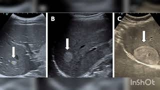 Liver Hemangioma [upl. by Kcirdneh]