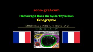 Échographie  Hémorragie Dans Un Kyste Thyroïdien [upl. by Ahserkal]