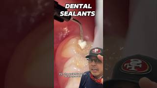 Step by Step Dental Sealants Procedure  In Office to Hands On Dental Training shorts [upl. by Rustice]