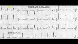 acute pericarditis ECG [upl. by Ravo698]