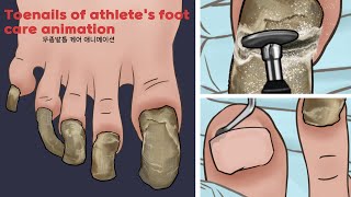 ASMR Satisfying Toenail of Athletes foot Treatment animation  Athletes foot foot care  TINGLES [upl. by Annaya54]