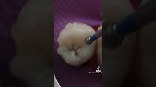 dentalcaries cavite dentist smiledental dentalsmiledesigning [upl. by Zerdna]