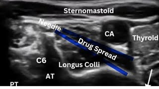 Stellate Ganglion Block for CRPS [upl. by Jo-Anne]