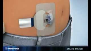 new Glucose Sensor Serter  MDEA 2013 Gold Winner [upl. by Rehtnug]