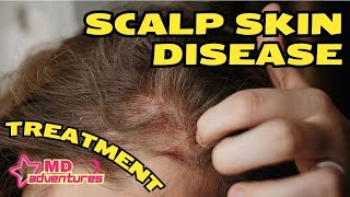 Scalp Skin Diseases amp Treatments [upl. by Enelaj]