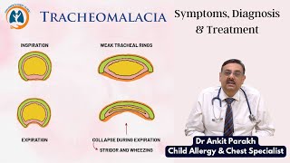 Tracheomalacia in children Symptoms Diagnosis amp Treatment I Dr Ankit Parakh Child Pulmonologist [upl. by Kelula]