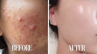 Get CLEAR SKIN subliminal  Get rid of acne in 10 minutes [upl. by Alian]