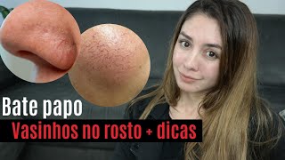 💛5 dicas para TRATAR VASINHOS NO ROSTO  Mais batepapo  PORQUE aparecem os vasinhos [upl. by Einhoj]