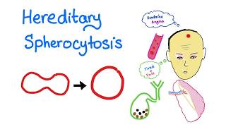 Hereditary Spherocytosis HS  Red Blood Cell Disorders  Hematology [upl. by Assereht472]