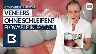 VENEERS VorherNachher  OHNE Schleifen Die Flowable Injection Technique [upl. by Ebeohp]