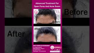 Advanced Treatment For Open Pores And Acne Scars  Dr Vimalas Skin Hair amp Laser Centre [upl. by Jar]