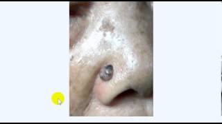 BASAL CELL CARCINOMA DR SAMEH GHAZY [upl. by Luhar693]