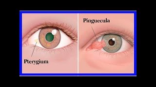 Augentumore Pinguecula und Pterygium [upl. by Iot]