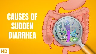 Causes of Sudden Diarrhea [upl. by Niveb]