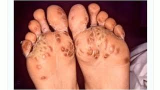 Keratoderma blennorrhagica in hindi  Tarang academy dermatology [upl. by Sukey]