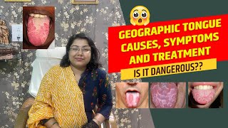 Is it dangerous Geographic tongue causes symptoms and treatment [upl. by Notkcorb]