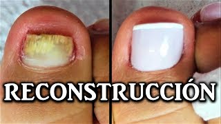 reconstruccion de uñas de pies con acrilico  nail reconstruction  reconstrução de unhas acrílico [upl. by Annaeoj299]