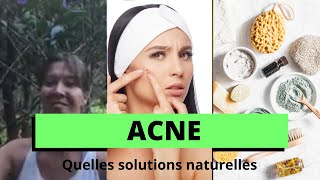 Acné  solutions naturelles [upl. by Tung]