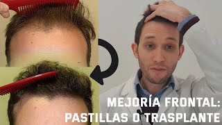 DERMATÓLOGO explica cómo mejorar la ALOPECIA ANDROGÉNICA FRONTAL [upl. by Orwin]