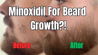 1 Year of Using Minoxidil For Beard Growth  Minoxidil for Beard Before and After [upl. by Oretna258]