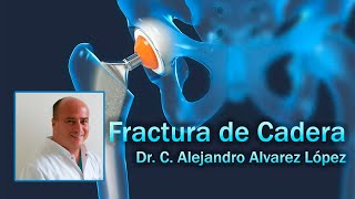 Fractura de Cadera en el adulto Mayor [upl. by Starks907]