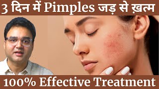 Pimples को बोलो अलविदा  4 Simple Steps To Remove Pimples amp Get Clear Spotless Skin Naturally [upl. by Siegfried]