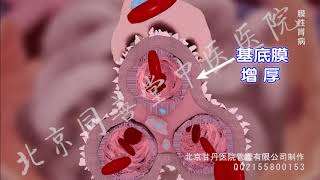 membranous nephropathy 3D animation [upl. by Buffo171]