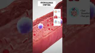 atherosclerosis causes symptoms in 3d animation 3d humanbody shortvideo medical 3danimation [upl. by Gert]