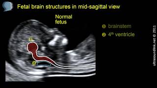 Open spina bifida at 1113 weeks gestation brainstem [upl. by Nirahs]