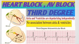 THIRD DEGREE HEART BLOCKAV BLOCKATRIOVENTRICULAR BLOCKأنسداد الدفيرة الكهربائيةأحصار القلب [upl. by Cameron]