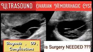 Ovarian Hemorrhagic Cyst Ultrasound  DD  Complications  Prognosis  Role of Surgery [upl. by Charry121]