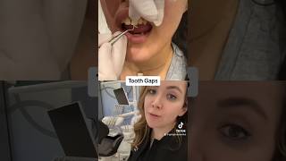 What Is The Problem With Closing Your Teeth Gaps With Composite [upl. by Sherrie]