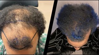 Hair Transplant Before and After  Month by Month results Elithair [upl. by Narret576]