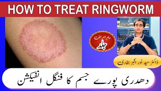 Ringworm Tinea Corporis Effective Treatments amp Prevention Tips For Fungal Infections [upl. by Geiger]