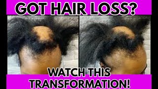 HAVE YOU TRIED THIS l PASSION TWIST l ALOPECIA l BALD SPOT COVER UP METHOD [upl. by Golding109]