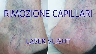 Rimozione dei capillari viola con il Laser VLight Medika [upl. by Naz]