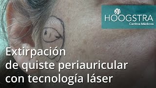 Extirpación de quiste periauricular con tecnología láser 16125 [upl. by Donn627]