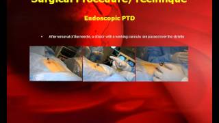 Posterolateral Endoscopic Thoracic Microdiscectomy with GPS System [upl. by Livvy96]