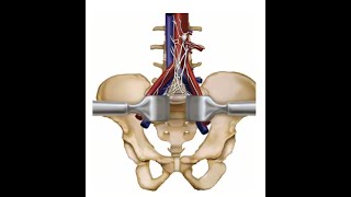 ALIF surgery post op recovery day 5 what to expect from back surgery [upl. by Van616]