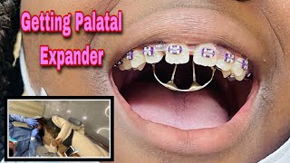 Getting Palatal Expander And She Not Too Happy [upl. by Now]