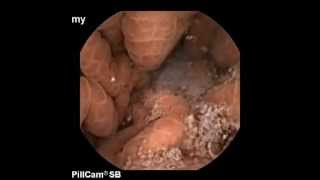 Capsule endoscopy in cirrhosis Portal Gastropathy [upl. by Asor]