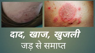 दाद खाज खुजली जड़ से समाप्त  luliderm cream  luliconazole cream ip [upl. by Nalyt]