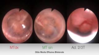 Otite media catarrale diagnosi endoscopica in paziente pediatrico [upl. by Yoccm]