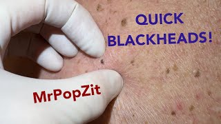 Quick and easy blackhead extractions Imbedded plugs removed with ease [upl. by Stover]