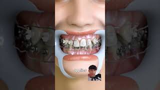 dentist braces history fypシ゚viral fy [upl. by Alliscirp]