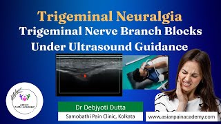 Trigeminal Nerve Branch Blocks Under Ultrasound  Dr Debjyoti Dutta  Asian Pain Academy [upl. by Dulci501]