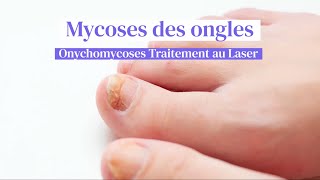 Mycoses des ongles  Traitement au laser chez Skin Marceau à Paris [upl. by Yelrebmyk]