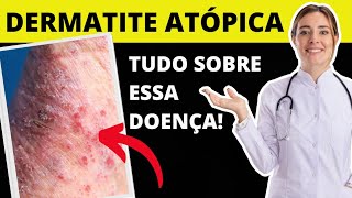 TUDO SOBRE DERMATITE ATÓPICA   O QUE É CAUSAS E TRATAMENTO [upl. by Ebenezer]